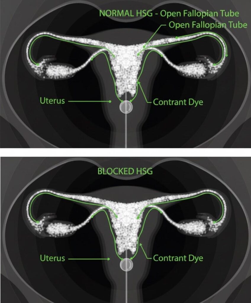 HSG test for open fallopian tubes