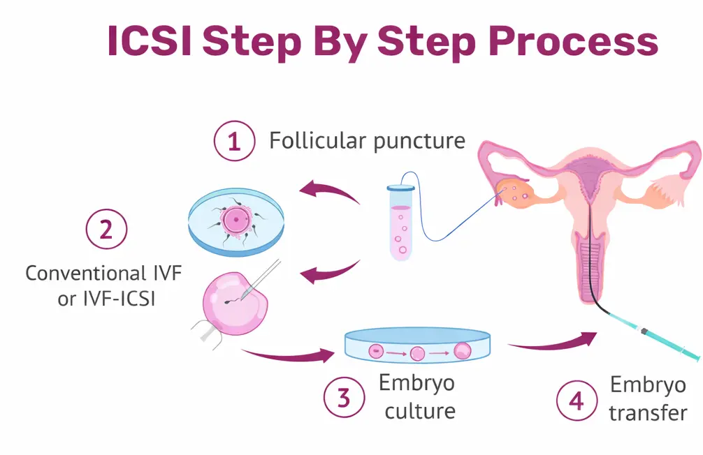 ICSI Treatment step by step