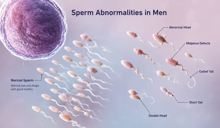 Sperm Abnormalities in Men